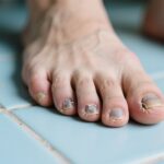 Onychomycosis: The Stubborn Fungal Invader of Nails – A Comprehensive Guide