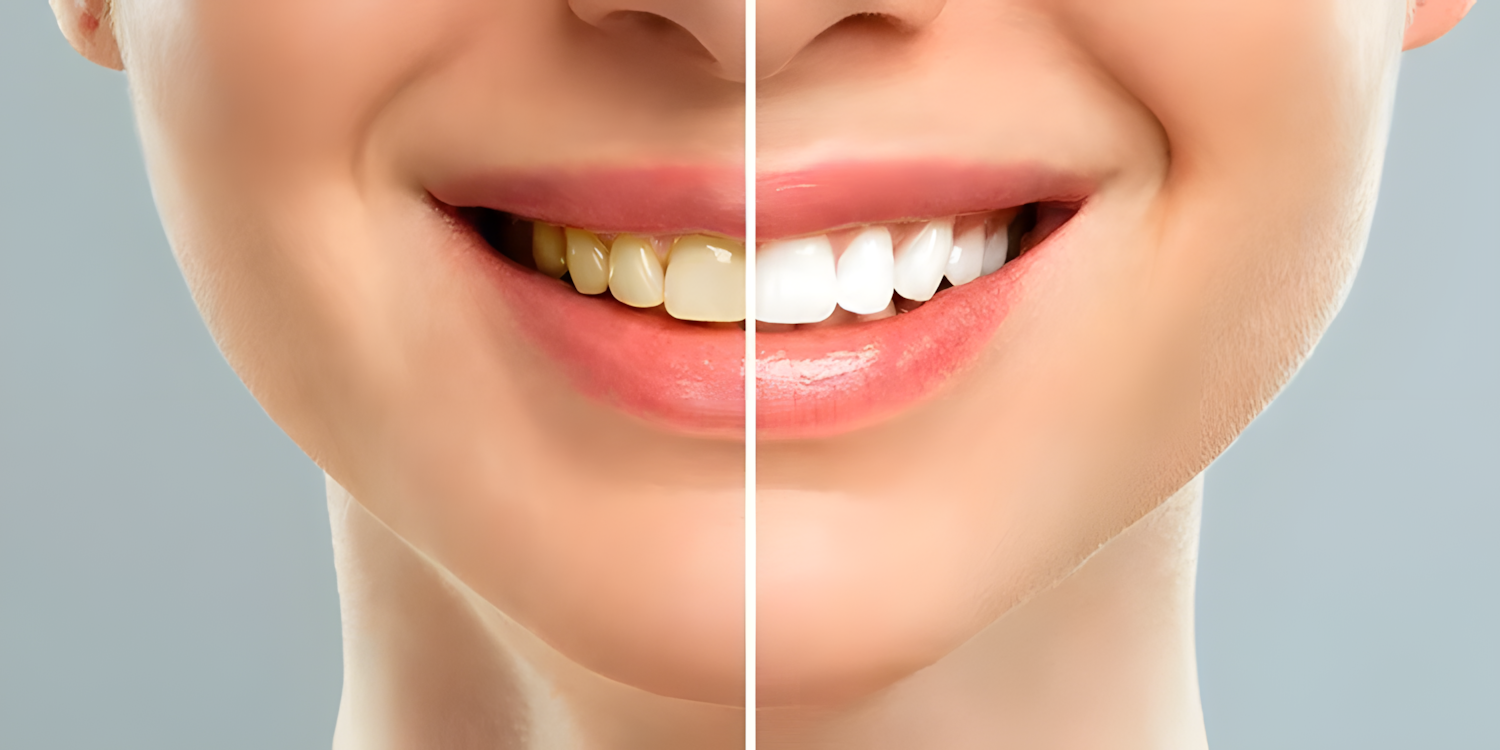 Read more about the article Unlock a Naturally Brighter Smile: The Truth About Teeth Whitening and How to Do It Safely